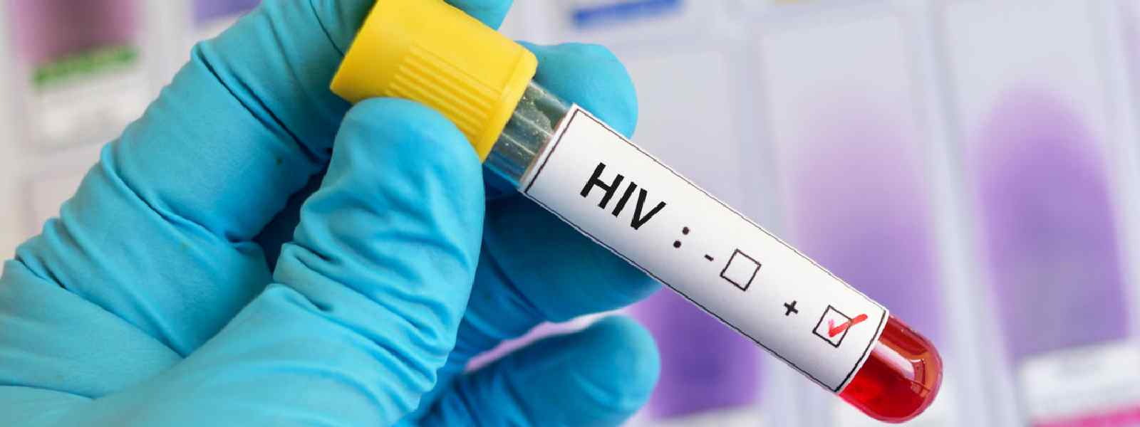 මෙරටින් වාර්තා වන HIV අසාදිතයින් සංඛ්‍යාව ඉහළට